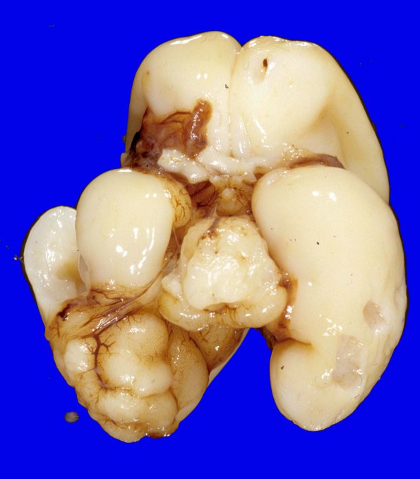 8A1 Heterotopia (Case 8) 1bA