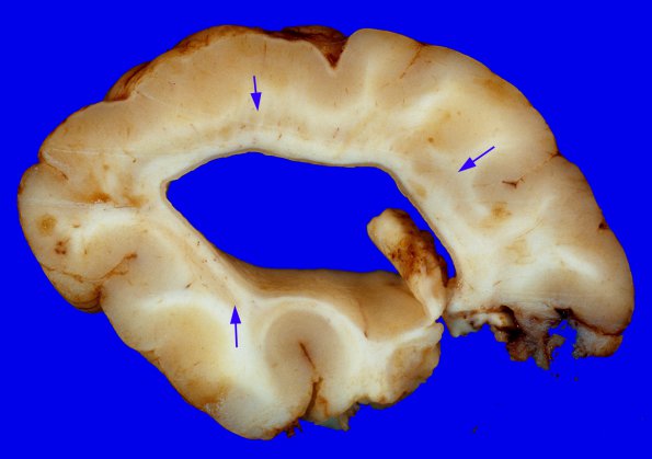 9A Heterotopia, subventricular (Case 9) gross 1A