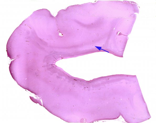 9B Heterotopia, subventricular (Case 9) H&E whole mount