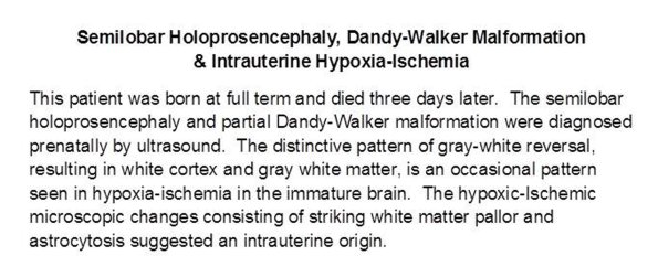 0A Complex Holoprosencephaly Malformation