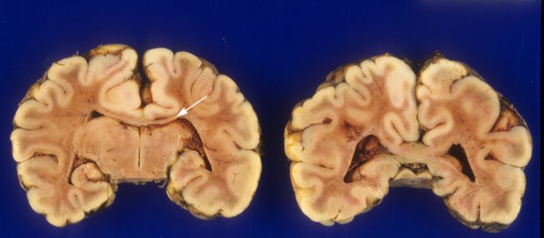 1A10 Holoprosencephaly, & Dandy-Walker & Hypoxia (Case 1) 6