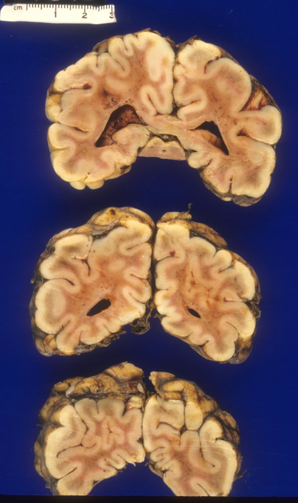 1A11 Holoprosencephaly & Dandy-Walker & Hypoxia (Case 1) 15