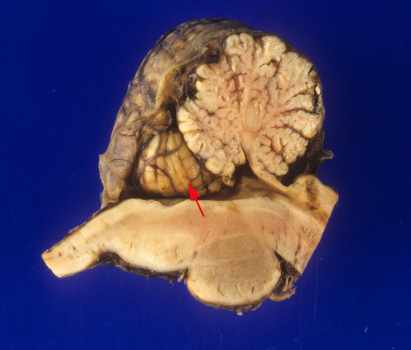 1A5 Holoprosencephaly & Dandy-Walker & Hypoxia (Case 1) 10