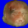 10A Holoprosencephaly, trisomy 13 (Case 10) Gross_1A