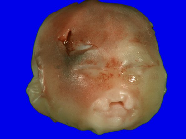 10A Holoprosencephaly, trisomy 13 (Case 10) Gross_1A