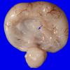 10B Holoprosencephaly, trisomy 13 (Case 10) Gross_7A