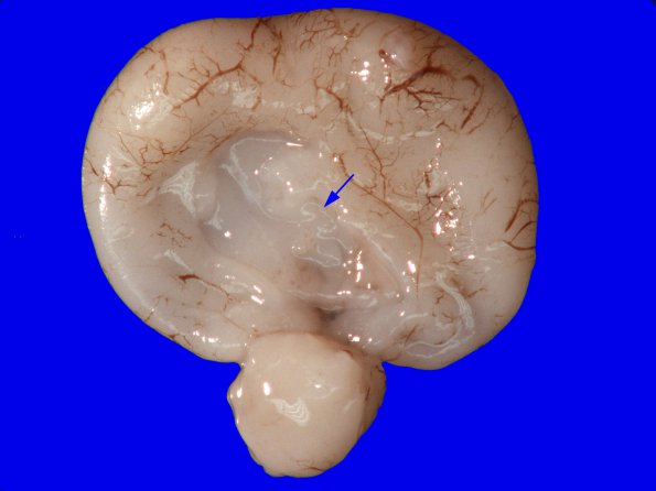 10B Holoprosencephaly, trisomy 13 (Case 10) Gross_7A