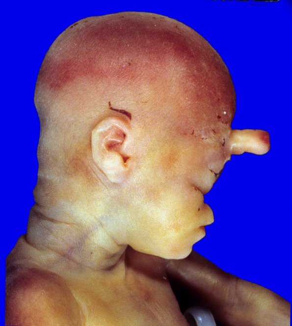 11A3 Holoprosencephaly (Case 11) 2A