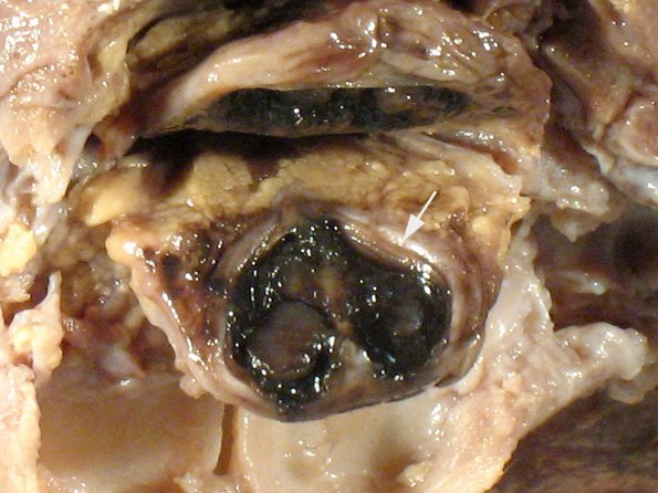 13A2 Holoprosencephaly (Case 13) 2 eye