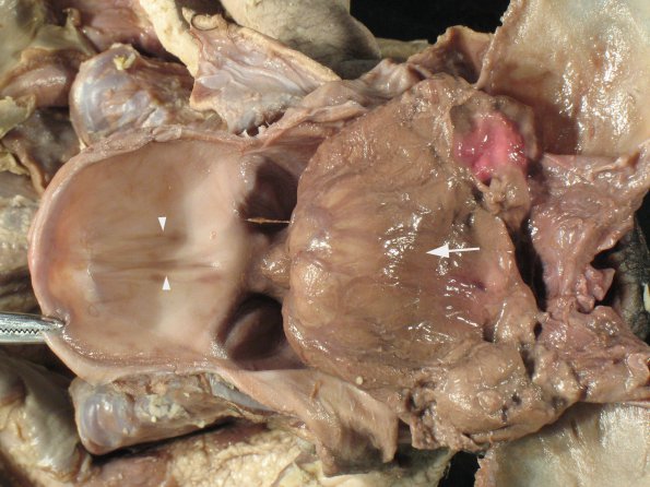 13A3 Holoprosencephaly (Case 13) 3