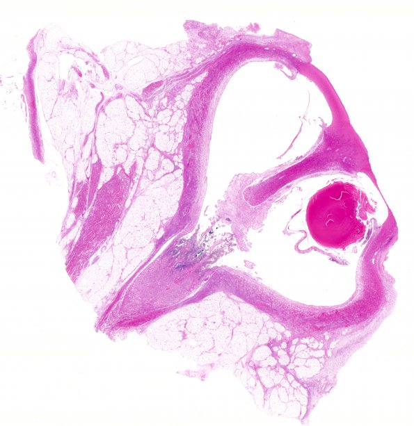 13B1 Holoprosencephaly (Case 13) eye H&E whole mount 1