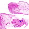 13B2 Holoprosencephaly (Case 13) proboscis H&E whole mount