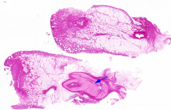 13B2 Holoprosencephaly (Case 13) proboscis H&E whole mount