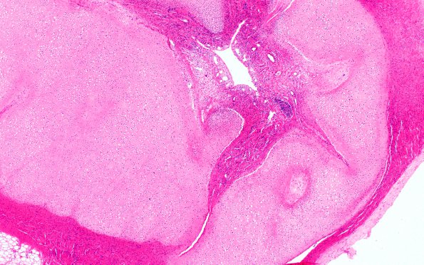 13B3 Holoprosencephaly (Case 13) proboscis H&E whole mount