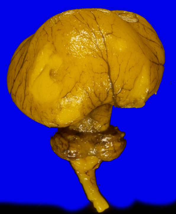 14B2 Holoprosencephaly (Case 14) A1A