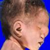 15A2 Holoprosencephaly & Anterior Encephalocoele (Case 15) 3A