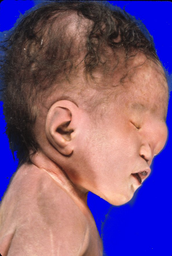 15A2 Holoprosencephaly & Anterior Encephalocoele (Case 15) 3A