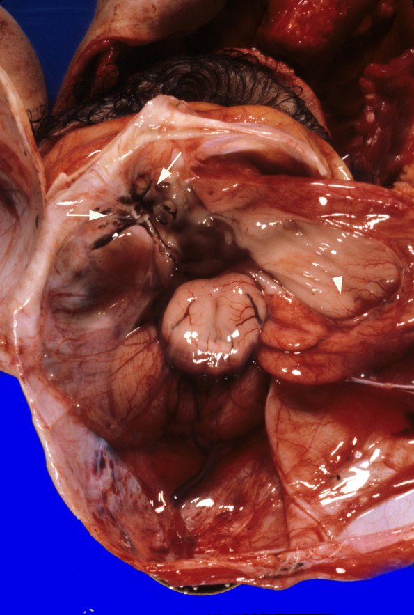 15B1 Holoprosencephaly & Anterior Encephalocoele (Case 15) 4A