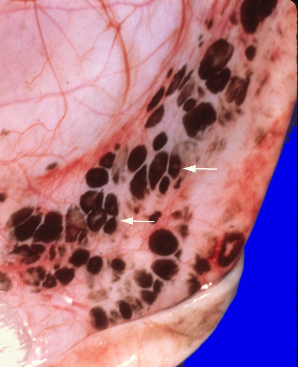 15B2 Holoprosencephaly & Anterior Encephalocoele (Case 15) 1A