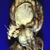 15B3 Holoprosencephaly (Case 15)  1