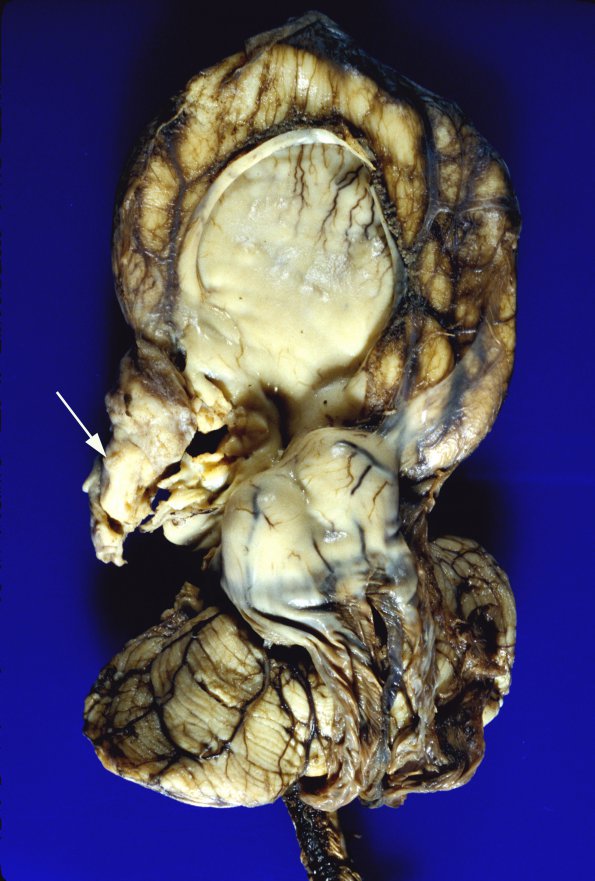 15B3 Holoprosencephaly (Case 15)  1