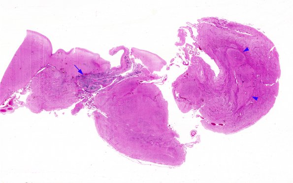 15C1 Holoprosencephaly (Case 15), with retina H&E whole mount