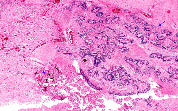 15C2 Holoprosencephaly (Case 15) E H&E 4X