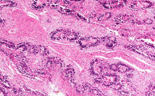 15C3 Holoprosencephaly (Case 15) E H&E 4X