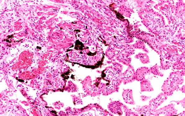 15C4 Holoprosencephaly (Case 15) E H&E 4X