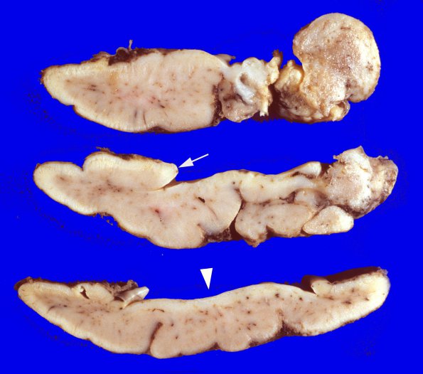 15D1 Holoprosencephaly (Case 15) 5A