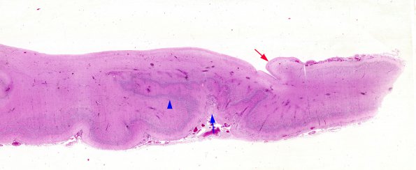 15D2 Holoprosencephaly (Case 15) B H&E whole mount