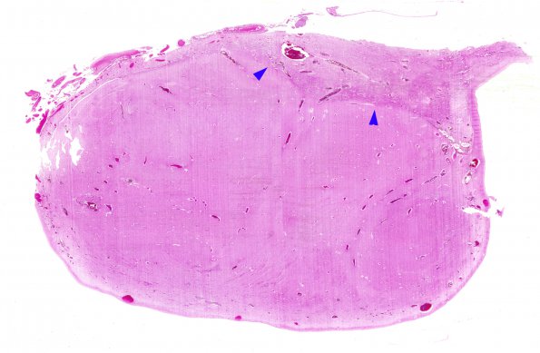 15E2 Holoprosencephaly (Case 15) F H&E whole mount