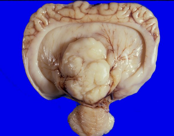 1A1 Holoprosencephaly (Case 1) 2A