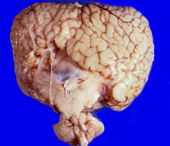 1A2 Holoprosencephaly (Case 1) 1A