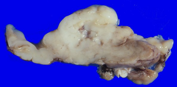 1A3 Holoprosencephaly (Case 1) basal ganglia gross 2A