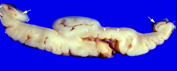 1A4 Holoprosencephaly (Case 1) 4A