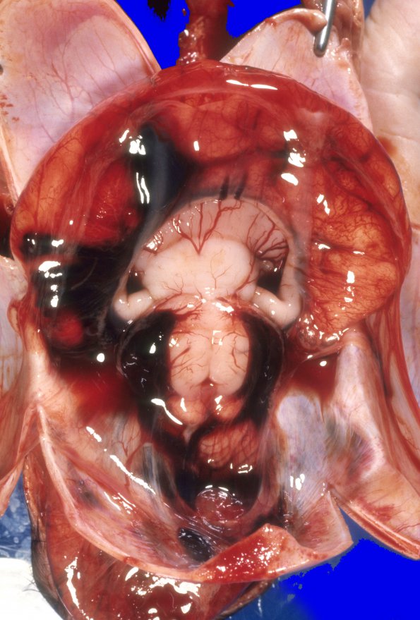 2A1 Holoprosencephaly (Case 2) 1