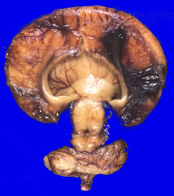 2A2 Holoprosencephaly (Case 2) untouched gross 1A