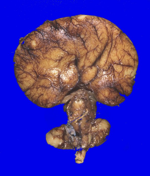 2A3 Holoprosencephaly (Case 2) untouched grossAA