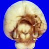 3A1 Holoprosencephaly (Case 3) 1A