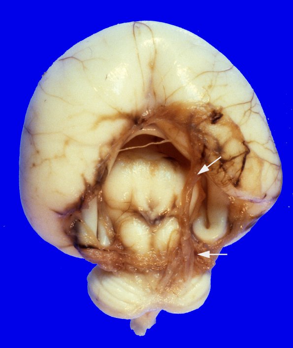 3A1 Holoprosencephaly (Case 3) 1A