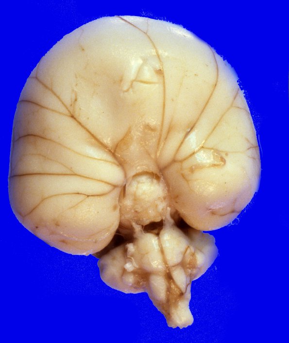 3A2 Holoprosencephaly (Case 3) 2A