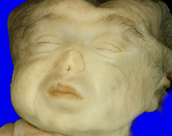 4A Holoprosencephaly (Case 4) 2A