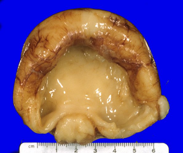 4B1 Holoprosencephaly (Case 4) 4A