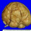 4B2 Holoprosencephaly (Case 4) 3A