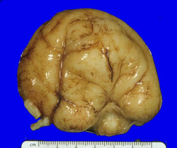 4B2 Holoprosencephaly (Case 4) 3A