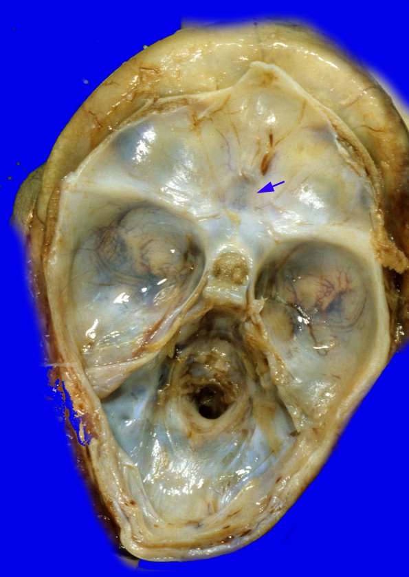 4B3 Holoprosencephaly (Case 4) gross 2A