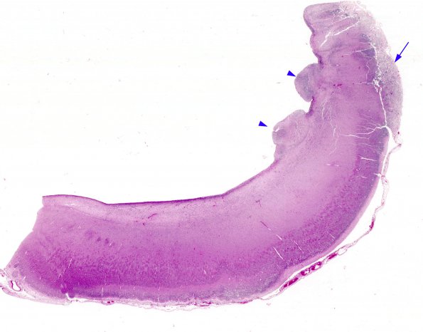 4C1 Holoprosencephaly (Case 4) N10 H&E whole mount