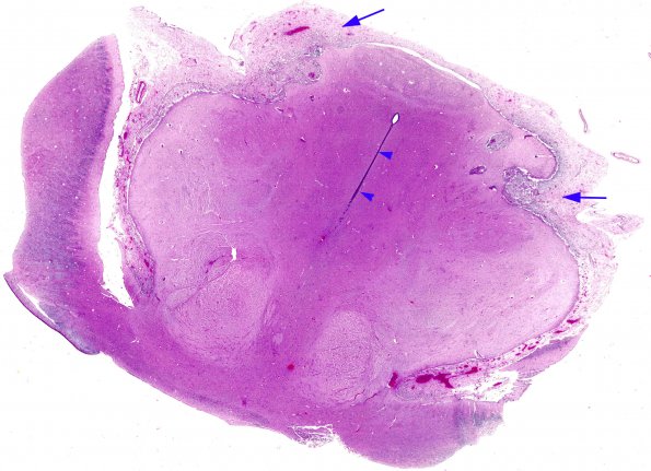 4C3 Holoprosencephaly (Case 4) N4 H&E whole mount