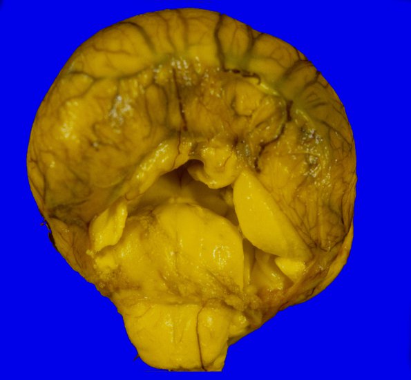 6A1 Holoprosencephaly (Case 6) 2A